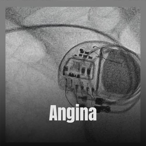 Angina