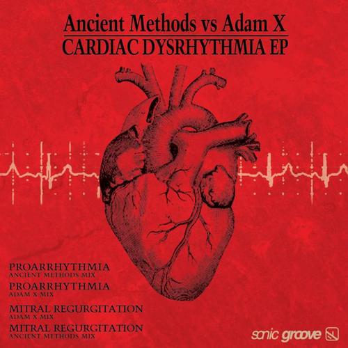 Cardiac Dysrhythmia